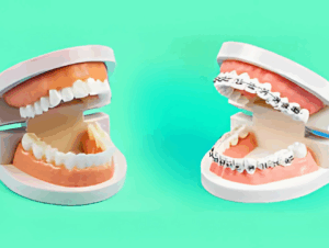 Clear Aligners or Metal Braces? Here’s How to Choose