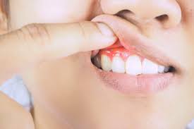 Gum Diseases