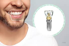 Dental Implants