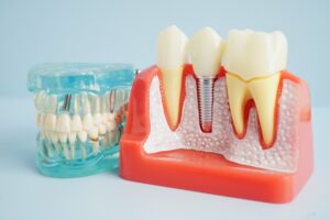 Root Canal Treatment Cost and Painless Dental Solutions in Gurgaon