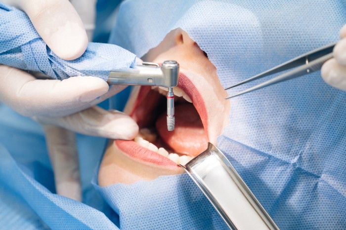 cavity treatment