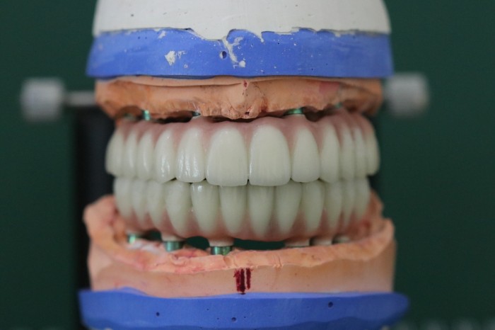full mouth treatment