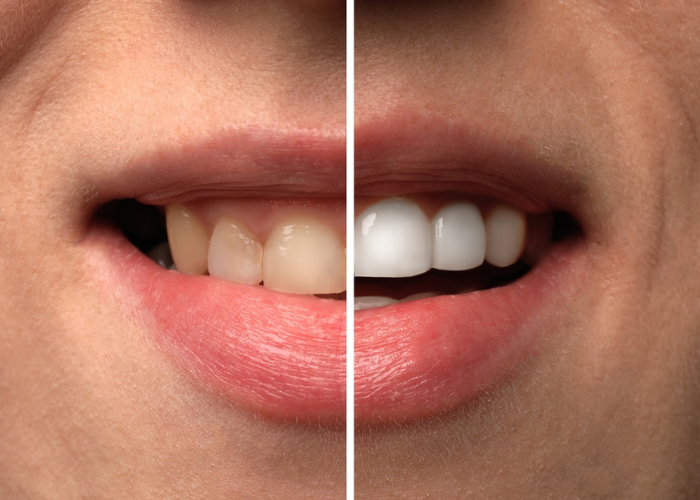 teeth whitening treatments