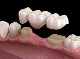 What Are the Advantages of Crowns and Bridges?