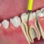 Root Canal Treatment