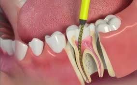 Is Root Canal Treatment Painful?