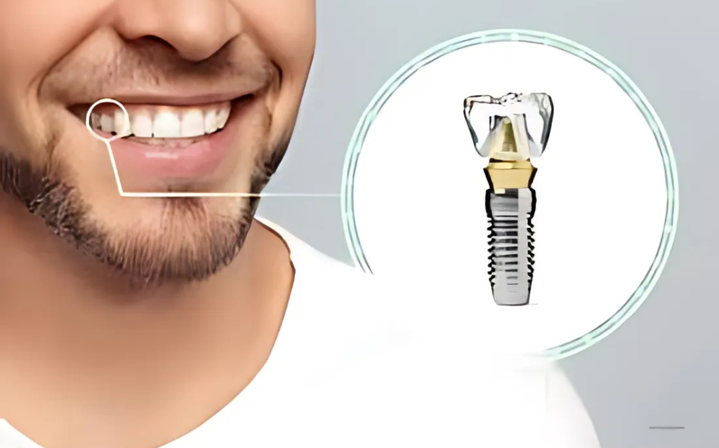 Dental Implants