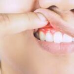 Gum Diseases
