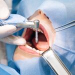 cavity treatment