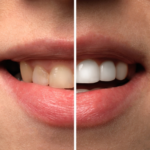 teeth whitening treatments